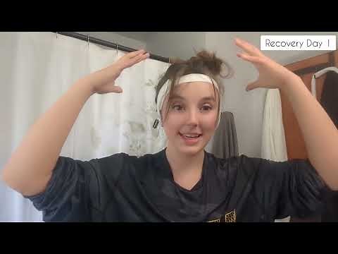 Surgery Recovery - Cochlear Implant - Osia 2 - Day After Surgery - Vlog (7.18.24-7.23.24)