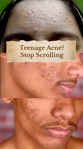 Why Expensive Creams Fail but This Yoga Pose Clears Teenage Acne. Yoga for pimple. Exercise for acne