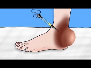 Grossly Satisfying ASMR | Cockroach Removal from Rear Foot Infection