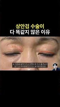상안검 수술 방법은 크게 두 가지예요안검 수술 방법은 크게 두 가지예요