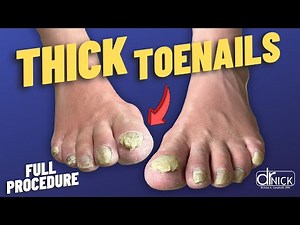 Cutting EXTREME THICK TOENAILS!! SATISFYING!