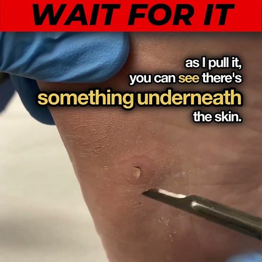 Warning: Shocking corn removal from foot of a patient by a podiatrist