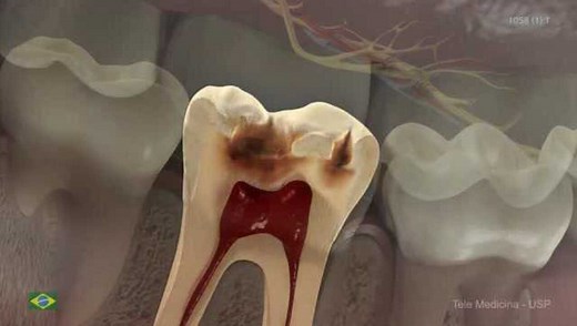 牙髓坏死的原因及过程，看看蛀牙是怎么来的！_高清1080P在线观看平台_腾讯视频