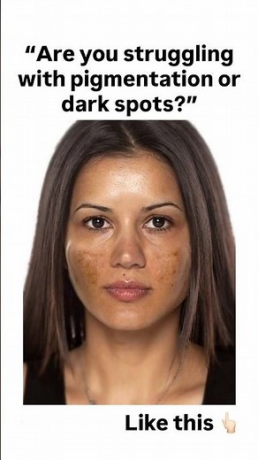✅Best Cream for Pigmentation & Dark Spots ✨ Fix Derma Skarfix TX #skindiscoloration #skincare
