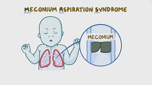 Video: Meconium aspiration syndrome: Nursing - Video Explanation! | Osmosis | Osmosis