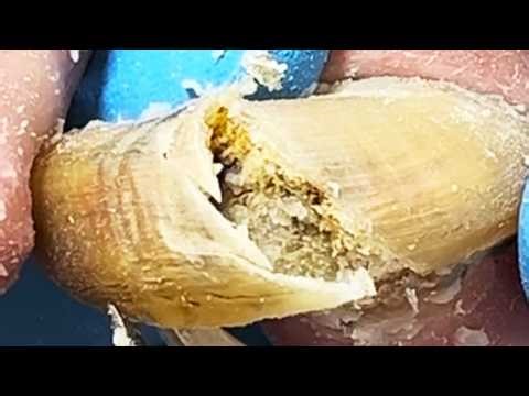 Professional Foot Care: Deep Cleaning Black Mud & Treating Onychomycosis【Podiatry Clinic】