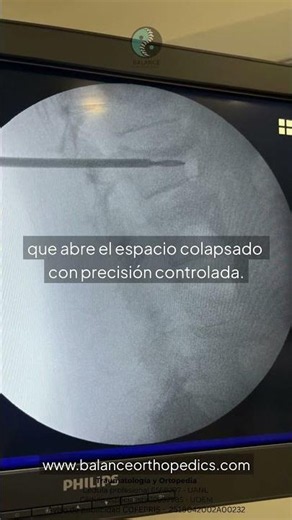 🦴 How we repair a fractured vertebra due to osteoporosis — without open surgery.