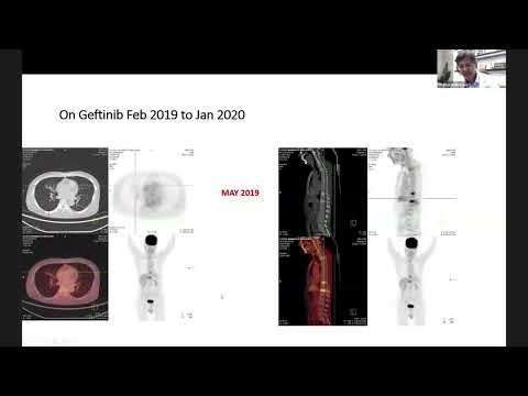 NGS & Liquid Biopsy in Lung Cancer: Moving Beyond Driver Mutations