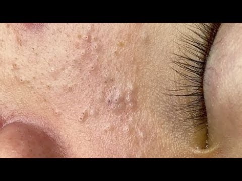 extreme deep cleansing asmr | acne & blackhead removal#089