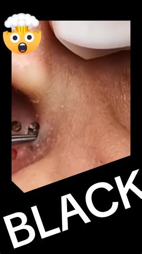 Pore Extraction Techniques for Clearer Skin