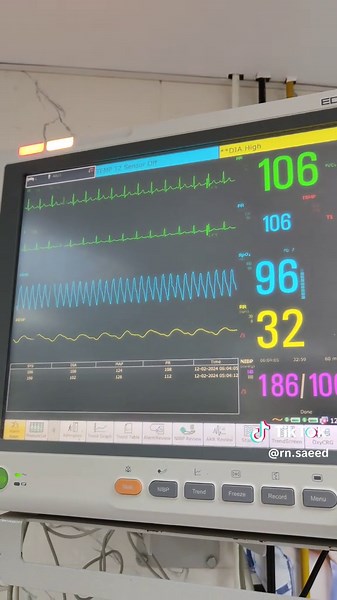 Understanding Cardiac Arrhythmia in Nursing