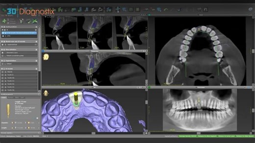 Single Implant Planning Masterclass | Surgical Guide Screw-Retained Restoration Workflow | Ahmed Safwat