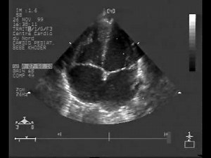 Atrial Septal Aneurysm With Chaotic Movement (1/2) • Video • MEDtube.net