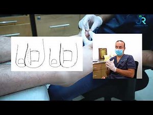 ¿Cómo funciona el tratamiento de la matricectomía en el pie?