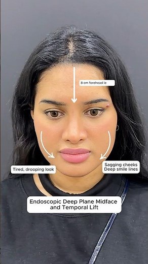 Endoscopic Deep Plane Midface 💆🏻‍♀️+ Temporal Lift ✨ #facelift #foreheadreduction Dr. Ahmet Dilber