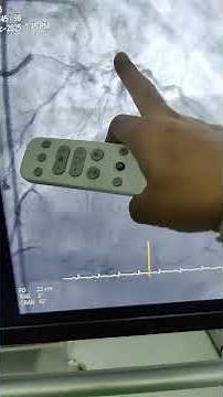 Triple Vessel Disease - Two CTOs RCA and LAD : Options Prof Dr Vivek Gupta 3.12.25