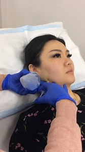 Masseter Hypertrophy