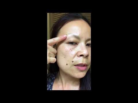 Update on mole remover pen