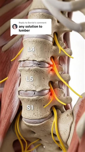 Replying to @Bernie Lumbar Spondylosis at L4-L5 & L5-S1: Could Artificial Disc Replacement Help? Not every patient with lumbar spondylosis at L4-L5 or L5-S1 needs spinal fusion. In carefully selected patients with disc-related pain, artificial disc replacement may be another treatment option. This 3D animation explains the type of disc degeneration that doctors evaluate before deciding on the most appropriate treatment. Which symptoms are you experiencing—lower back pain, leg pain, numbness, or 