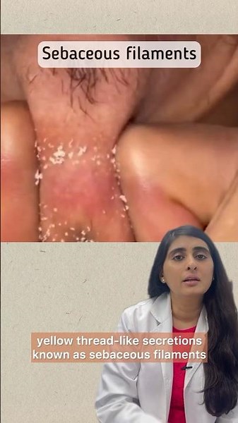 Blackheads whiteheads removal or sebaceous filament removal? | Blackhead removal