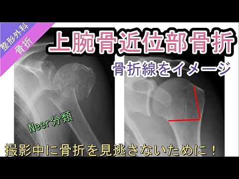 骨折を見逃さない技術：上腕骨近位部骨折