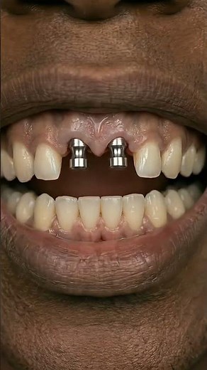 Missing Front Teeth FIXED Instantly !