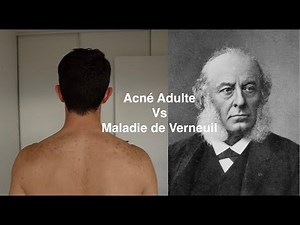Acné Adulte Vs Maladie de Verneuil