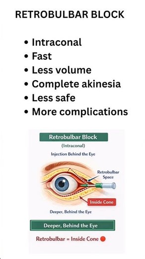 PeribulbarVs Retrobulbar Blocks Opthalmic #Anaesthesia #Quick Revision