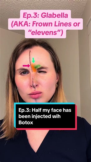 EPISODE 3: The Glabella 🪗 This episode is about treating #frownlines otherwise known as “elevens” or the #glabella region. 😾 The glabella is the area between the eyebrows and above the nose, and is composed of 3 main muscle groups: 1. The procerus 2. Corrugator supercilii 3. The depressor supercilii When we stragegically place #neuromodulators (i.e., botox or dysport) into this area, we can ✨soften✨ the strength of the glabella complex by reducing the ability to frown. I absolutely love it, as