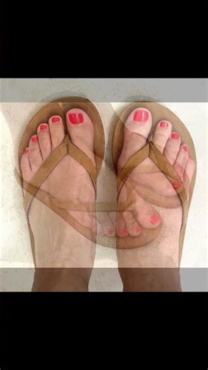 KINDA LIKE MAGIC!🪄#shorts #brachymetatarsia #brachymetatarsiasurgery #braquimetatarsia