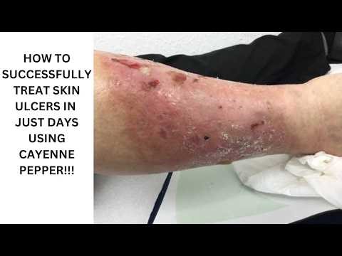 Successfully Treat That Embarrassing Skin Ulcer Using Cayenne Pepper