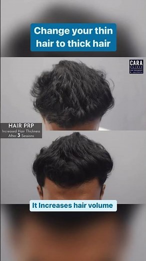 PRP Treatment Results In 3 Sessions | Before and After results of PRP | PRP at Cara clinic