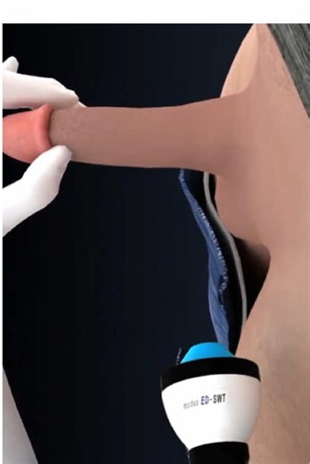 Shockwave Lithotripsy (3D Animation) | Kidney Stones Removal#shockwavelithotripsy #kidneystone #kidneystonesurgery #kidneystonesremoval #shockwavetherapy