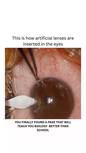 BIOLOGY | HEALTH | MEDICAL on Instagram: "Artificial lenses are inserted in the eye to correct vision problems caused by conditions like cataracts, keratoconus, or severe corneal damage. These lenses, such as intraocular lenses (IOLs) or keratoprostheses, help restore vision by replacing or supporting the natural lens or cornea, improving quality of life for individuals with specific eye conditions. Dm for credit or removal 👏🏻🙏🏻 For educational purposes only……. #v