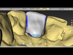 ✅Como Diseñar en inlab 19 Sirona 🦷 (How to Design inlab 19 Sirona)
