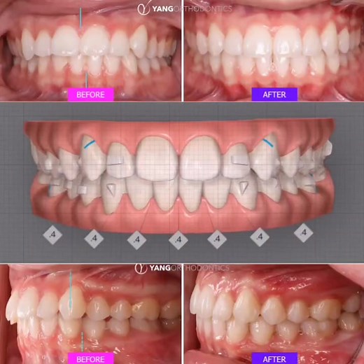 Asymmetrical class II correction with @invisalignofficial #invisalignbeforeandafter #invisalignsmile #clearaligners #orthodontist #braces
