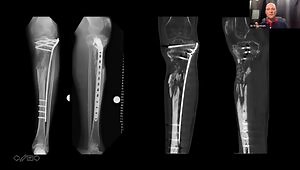 The Management of Bone Defects with Bone Transport Techniques
