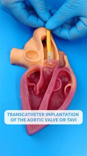 Can This Tiny Tube Save a Heart?