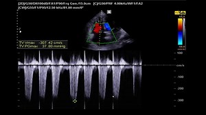 13K views · 171 reactions | The assessment of diastolic dysfunction is very difficult in the presence of AF because of the absence of the A wave. An evidence-based method to diagnose diastolic dysfunction and LT ventricle filling pressure in the presence of AF straightforwardly [new guidlines] | Hands on critical care U/S courses | Facebook