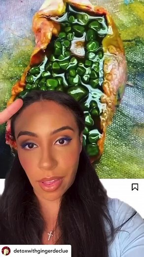 Natural Remedies for Gallstones Removal and Detoxification