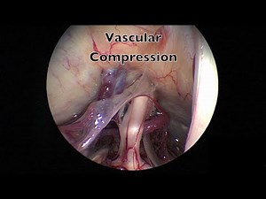 Endoscopic Microvascular Decompression for Trigeminal Neuralgia • Video • MEDtube.net