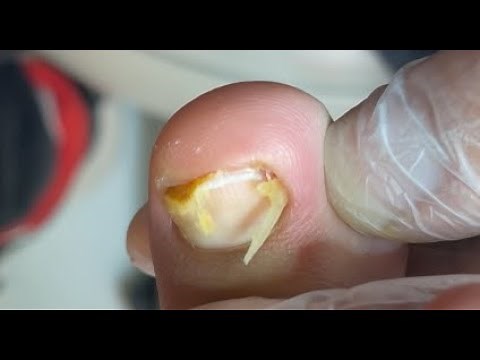 Effective way to cut ingrown nail