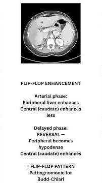 Budd-Chiari Syndrome — When the Liver's Veins Are Blocked