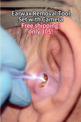 If you're not using these, START😅 ear wax removal tool with camera earcleaning #earwax #eardrum #earwaxremovaltool #tiktokshopdeals #tiktokshopfinds #tiktokshoploveatfirstfind