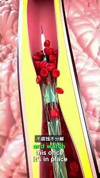 ny stent saves your life by opening blocked arteries instantly #shorts #medical