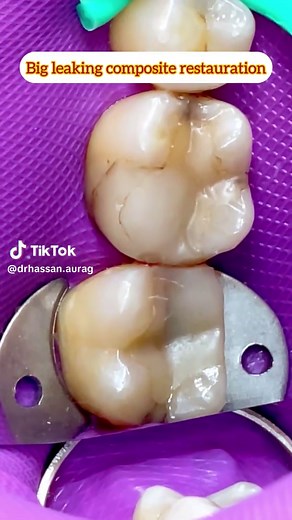Lower Molar Onlay Preparation with MDPT Technique