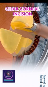 Clear Corneal Incision in Ophthalmic Surgery | Step-by-Step Eye Surgery Guide. #OphthalmicSurgery #ClearCornealIncision #EyeSurgery #CornealIncision #CataractSurgery #MinimallyInvasiveEyeSurgery #Ophthalmology #SurgicalEyeCare #MedicalAnimation #VisionRestoration #Microsurgery #EyeHealthAwareness #SurgeonEducation | Medical Animation Media