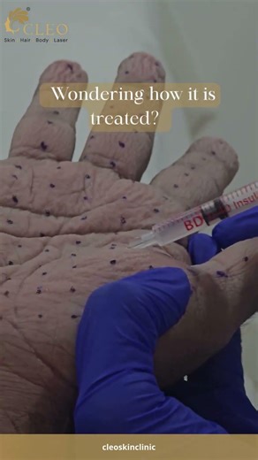 Botox Treatment for Sweaty Palms | Palmar Hyperhidrosis Solution