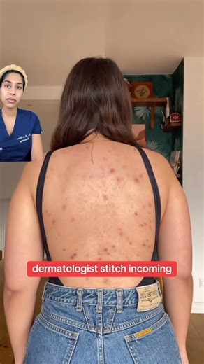 Dr. Neera Nathan on Instagram: "how to get rid of bacne for severe back acne, seek care from a board certified dermatologist @selflove_aida #bacne #bodyacne #dermatologist #skincareroutine"