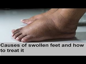 Causes of swollen feet and how to treat it